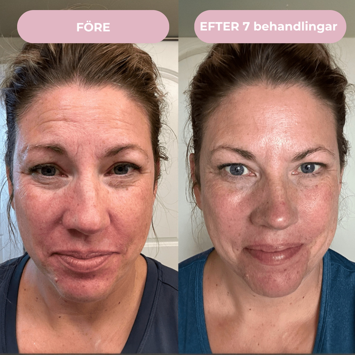 Glow Micro Infusion Kit™