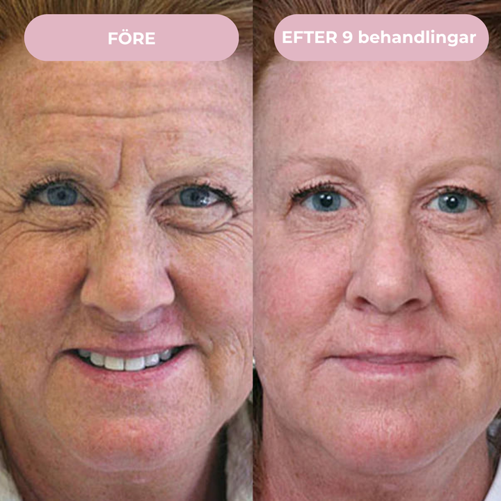 Glow Micro Infusion Kit™