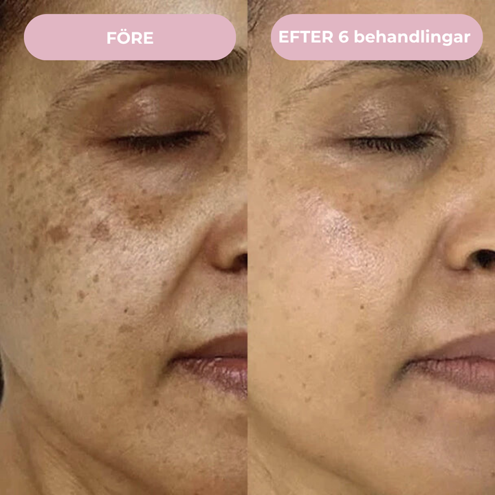 Glow Micro Infusion Kit™